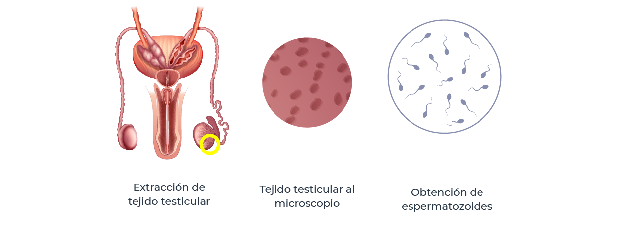 Biopsia testicular Biopsia testicular