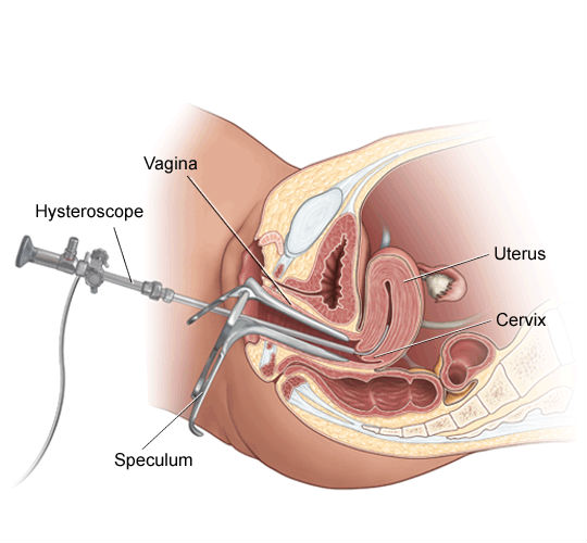 Histeroscopia Histeroscopia